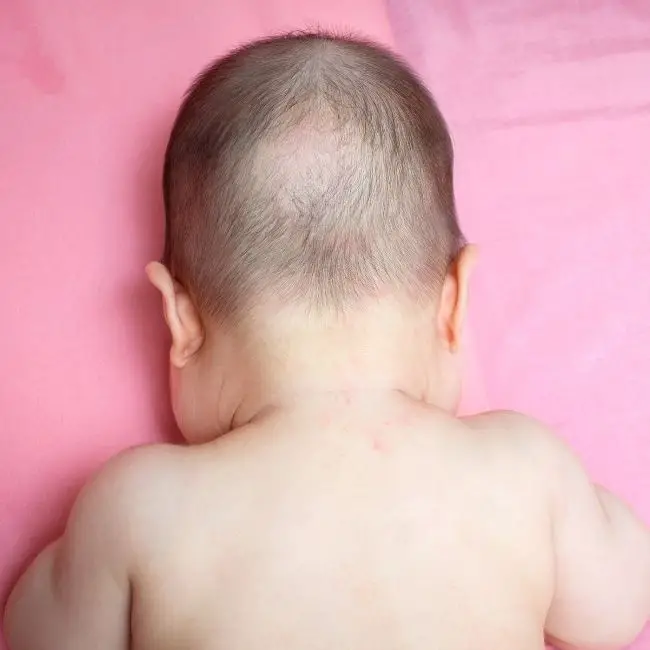 baby bald spot